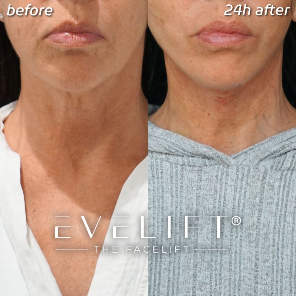female patient before and after EVELIFT®