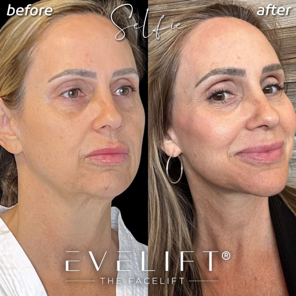 female patient before and after EVELIFT®